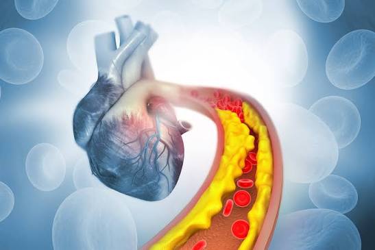 Edta Chelation Therapy